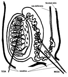 Percutaneous Epididymal Sperm Aspiration (PESA)